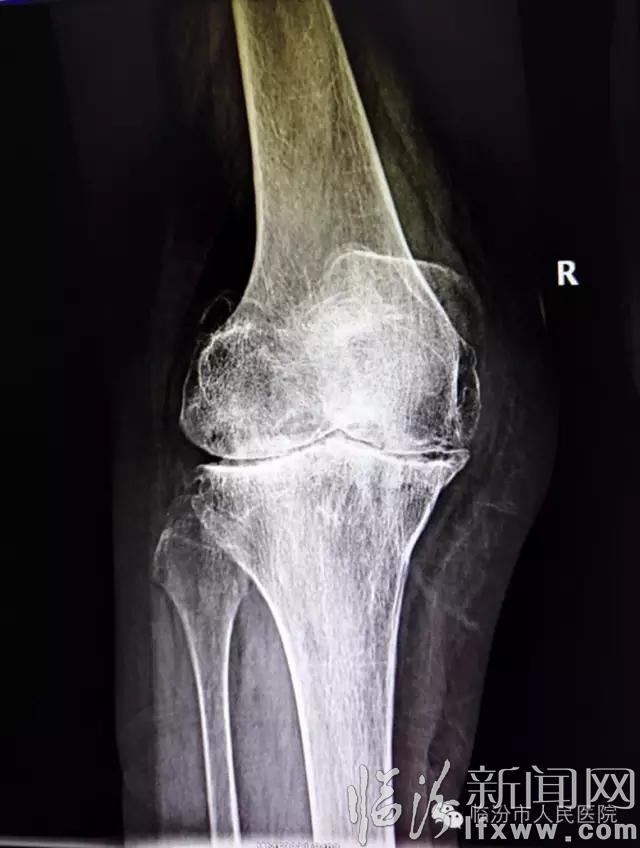 临汾市人民医院骨科完成膝关节强直畸形人工全膝关节置换术